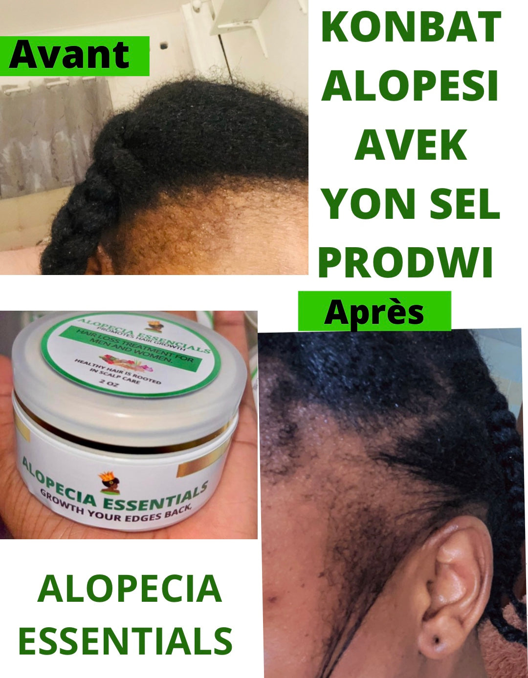 ALOPECIA ESSENTIALS ( Regrowth your edges)