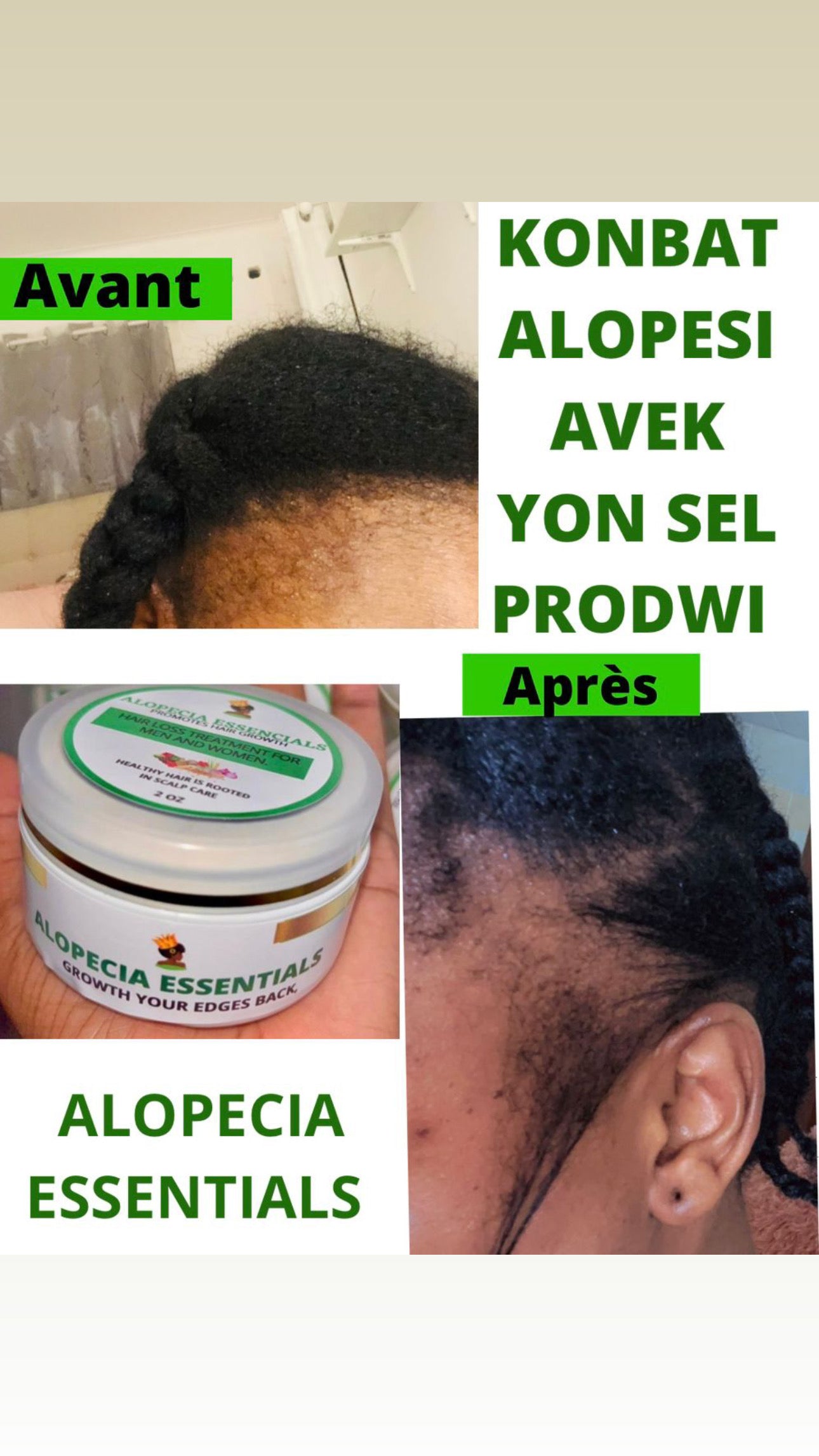 ALOPECIA ESSENTIALS ( Regrowth your edges)